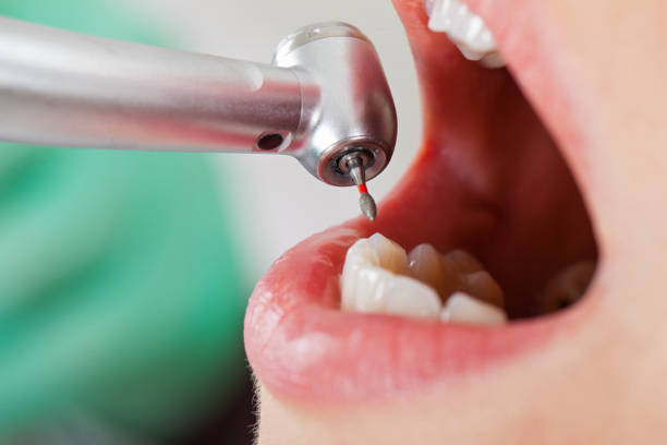 Tooth Infection Emergency Dentist in GA